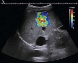 الاستوگرافی و سونوگرافی کبد الاستوگرافی و سونوگرافی کبد