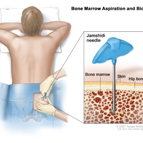 بیوپسی آسپیراسیون یا بافت برداری