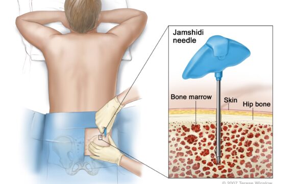 بیوپسی آسپیراسیون یا بافت برداری بیوپسی آسپیراسیون یا بافت برداری
