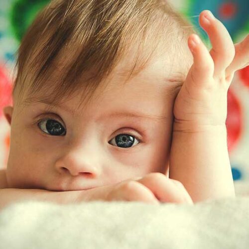 سندروم داون از تشخیص تا پیشگیری