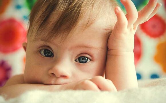 سندروم داون از تشخیص تا پیشگیری سندروم داون از تشخیص تا پیشگیری