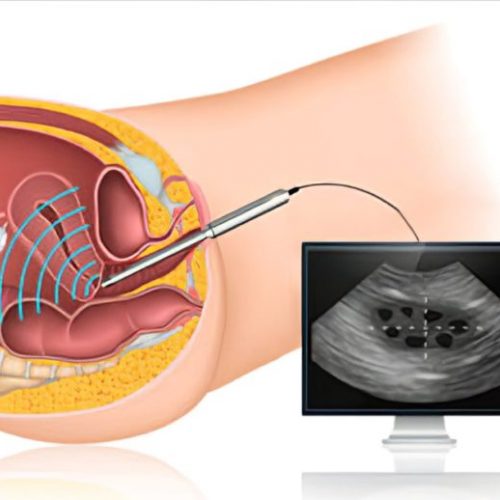 سونوگرافی واژینال چیست؟