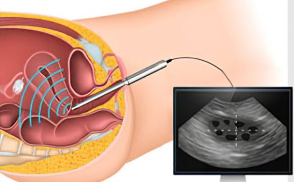 سونوگرافی واژینال چیست؟ سونوگرافی واژینال چیست؟