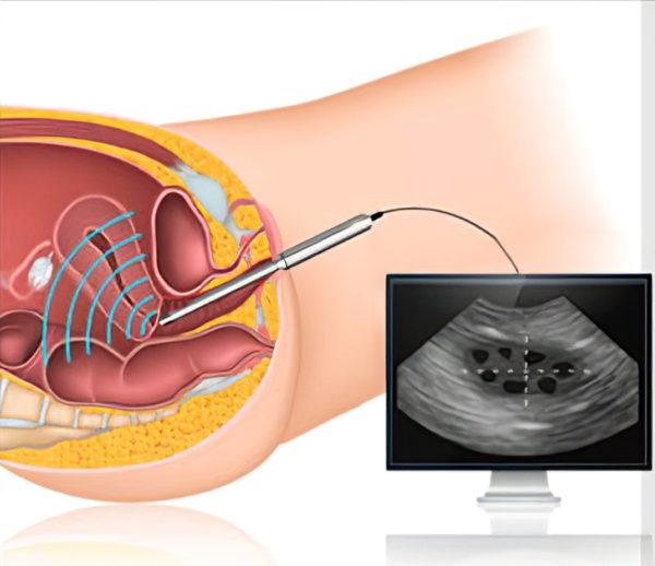 سونوگرافی واژینال چیست؟ سونوگرافی واژینال چیست؟