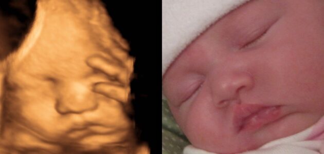 سونوگرافی سه بعدی