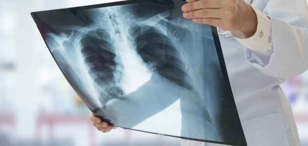 رادیولوژی ریه