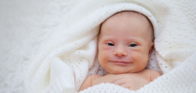 سندروم داون