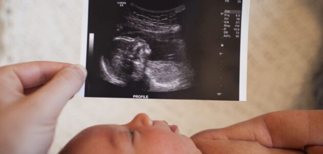 NT سونوگرافی