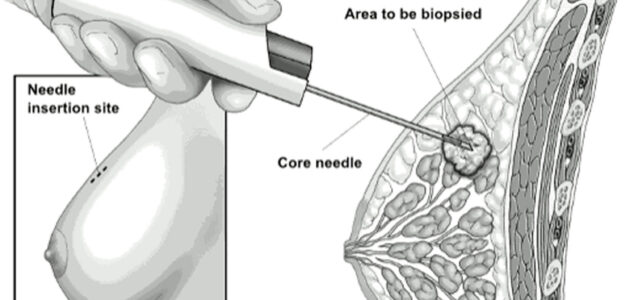 بیوپسی سینه