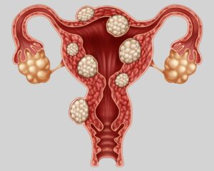 اندومتریوز و تشخیص آن