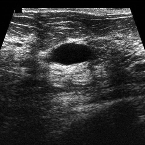 سونوگرافی سینه