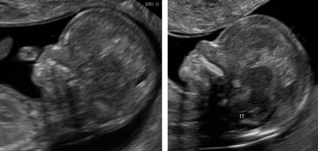 NT سونوگرافی